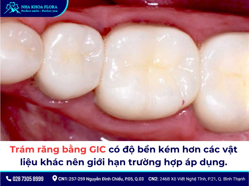 Trám răng bằng GIC thường áp dụng cho các trường hợp răng sâu ít hay răng cửa