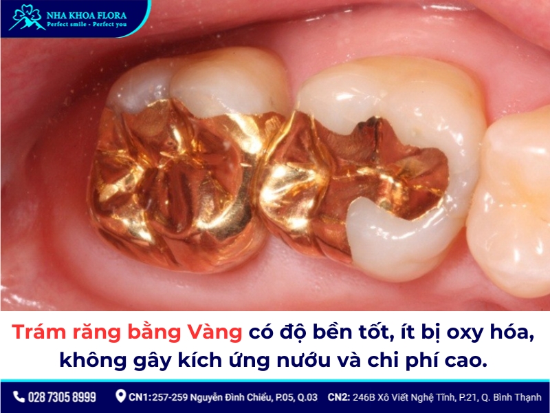 Trám răng bằng vàng có độ bền tốt nhưng chi phí cao và ít được áp dụng cho các vị trí nhóm răng cửa phía trước