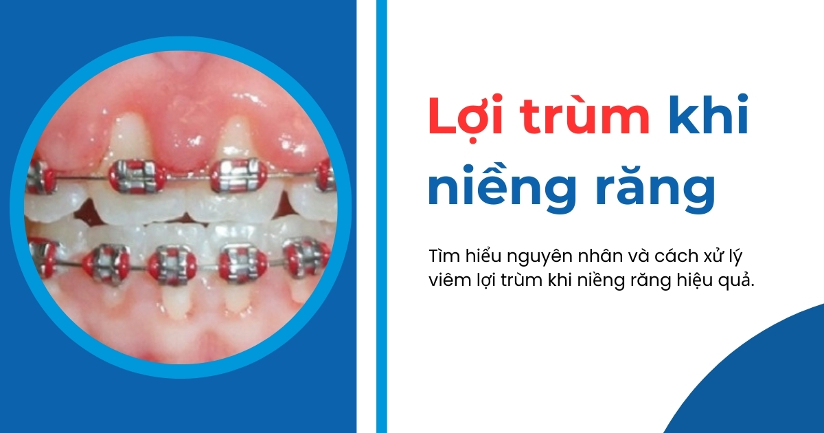 Lợi trùm khi niềng răng do đâu? Cách khắc phục thế nào?