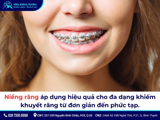niềng răng - ảnh 2 niềng răng - ảnh 2