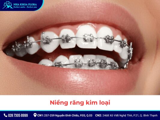niềng răng - ảnh 4 niềng răng - ảnh 4