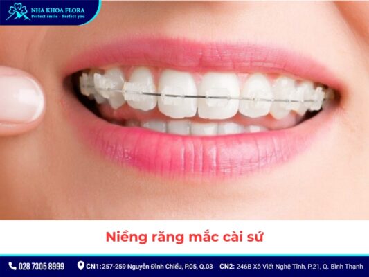 niềng răng - ảnh 5 niềng răng - ảnh 5