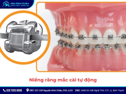 niềng răng - ảnh 6 niềng răng - ảnh 6
