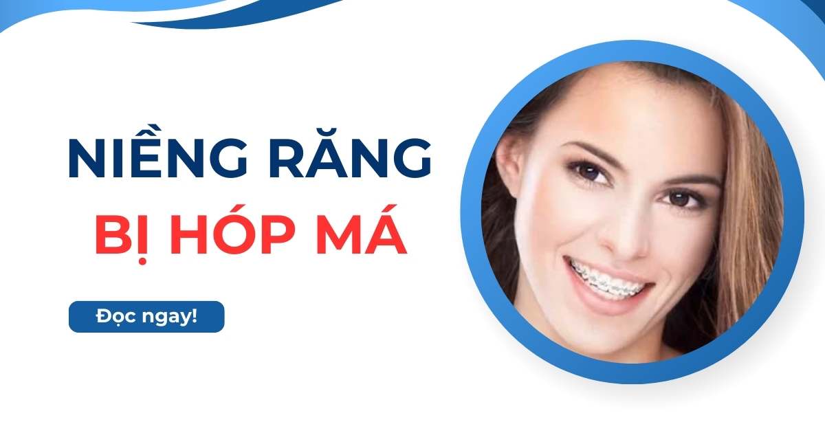 Niềng răng bị hóp má, hóp thái dương phải làm sao để hết?