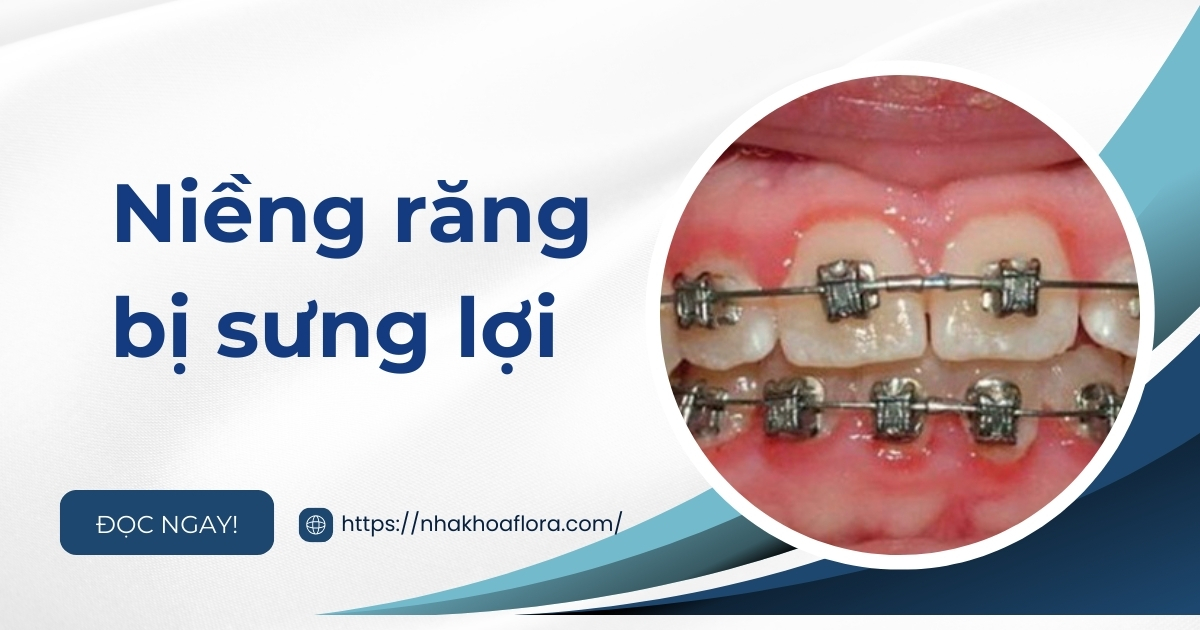 Niềng răng bị sưng lợi: Nguyên nhân và biện pháp khắc phục