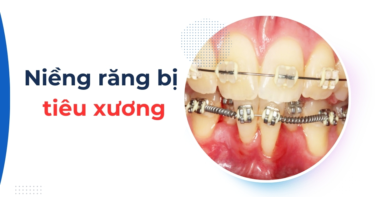 Niềng răng bị tiêu xương: Nguyên nhân và cách khắc phục