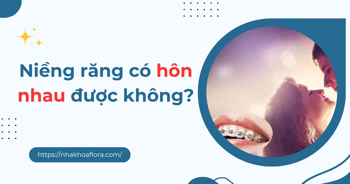 Niềng răng có hôn nhau được không? Bỏ túi cách hôn an toàn