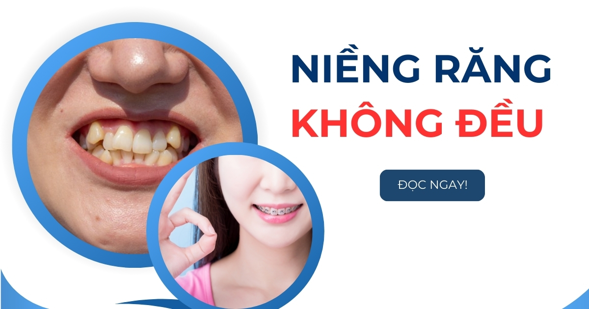 Niềng răng không đều có hiệu quả không? Giá bao nhiêu tiền?