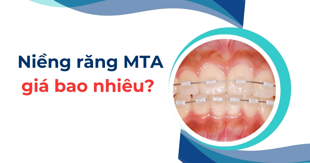 Niềng răng MTA giá bao nhiêu tiền? Bảng giá chỉnh nha MTA