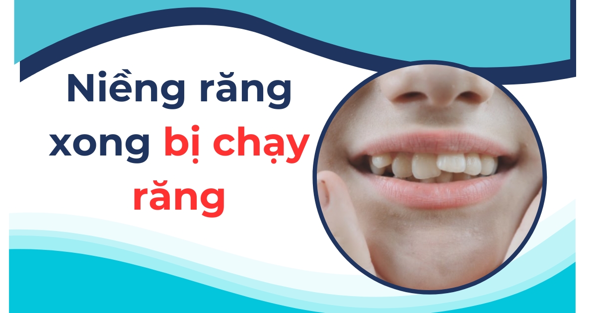 Niềng răng xong bị chạy răng: Nguyên nhân và cách khắc phục
