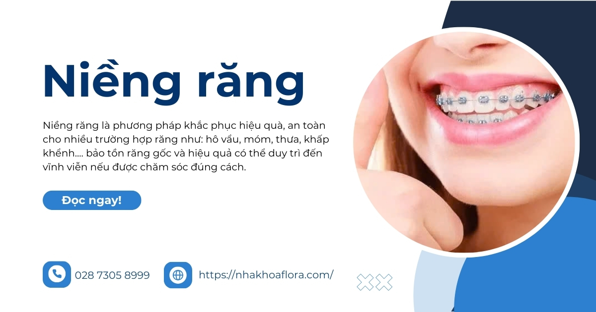 Niềng răng là gì? Có tốt không? Chi phí hết bao nhiêu tiền?