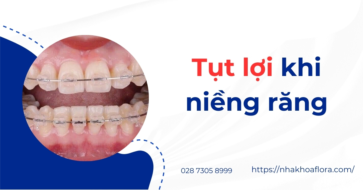 Tụt lợi khi niềng răng: Dấu hiệu, Nguyên nhân & Điều trị