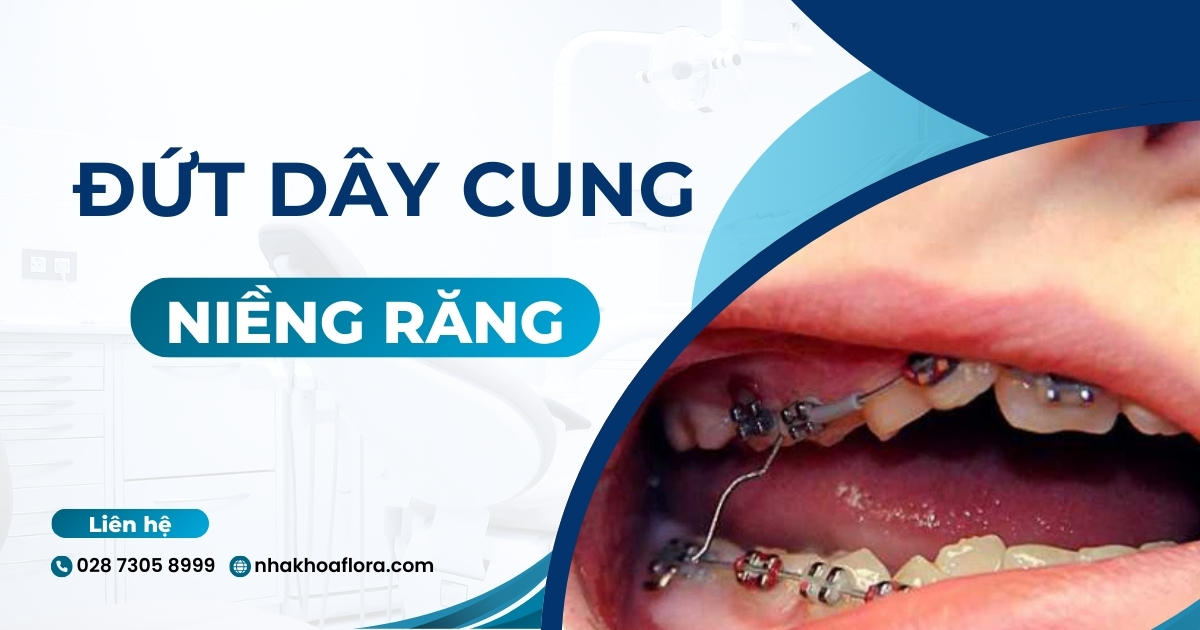 Đứt dây cung niềng răng: Nguyên nhân và giải pháp xử lý