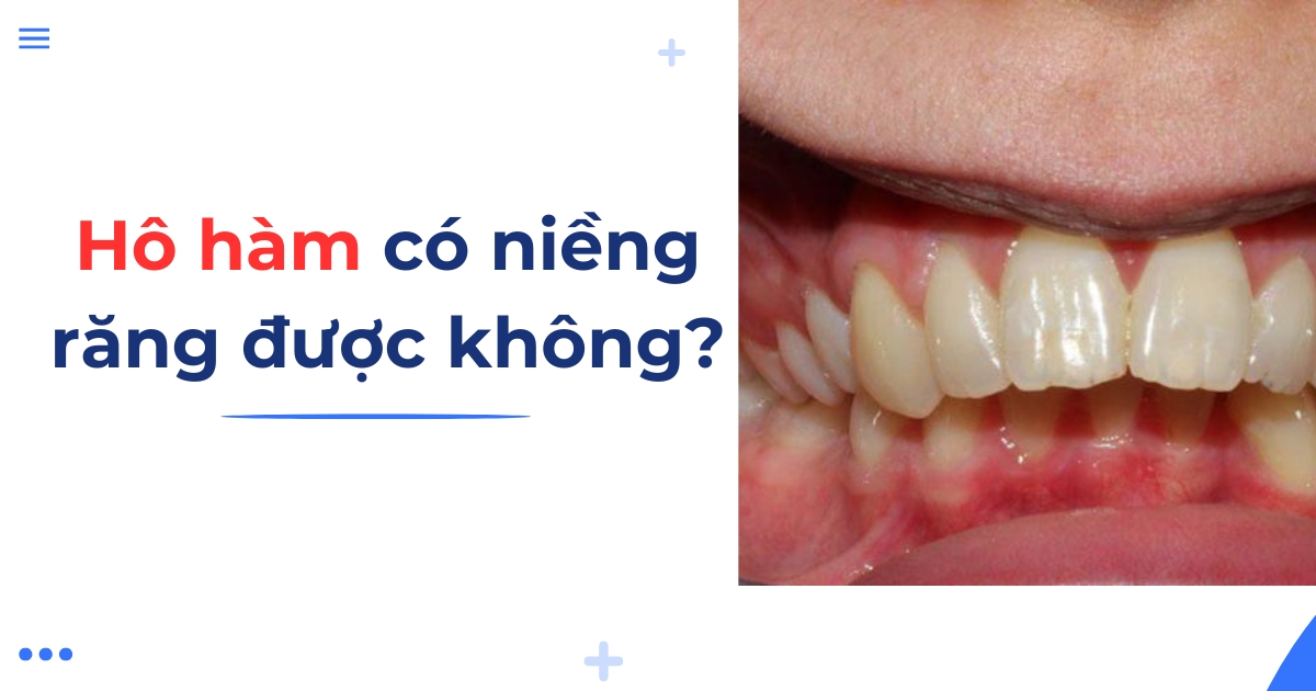 Hô hàm có niềng răng được không? có cải thiện hay không?