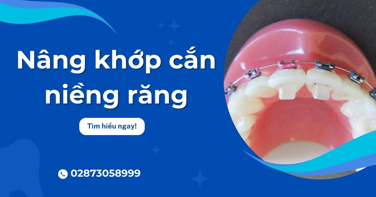 Nâng khớp cắn niềng răng là gì? Mất bao lâu? Giá bao nhiêu?