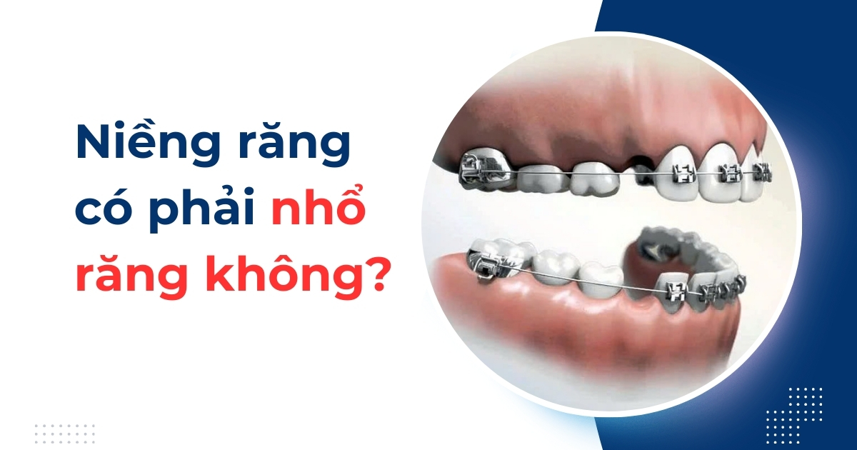 Niềng răng có phải nhổ răng không? Khi nào không cần nhổ?