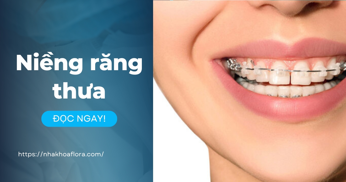 Niềng răng thưa có nên không? Mất bao lâu? Giá bao nhiêu?