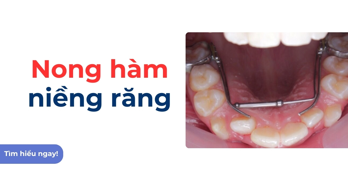 Nong hàm niềng răng là gì? Có đau và có thay đổi khuôn mặt?