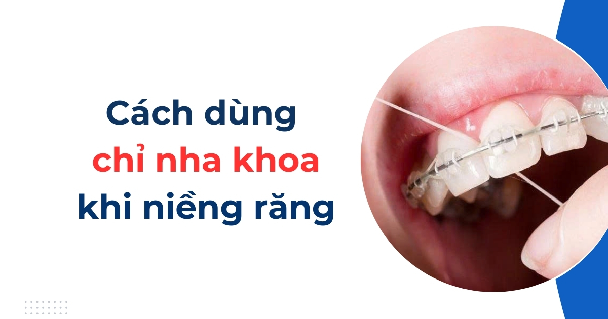 Cách dùng chỉ nha khoa khi niềng răng đúng cách, an toàn