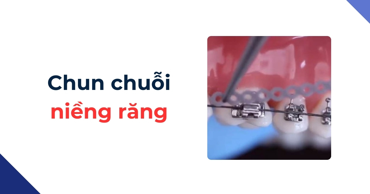 Chun chuỗi niềng răng là gì? Công dụng? Đeo trong bao lâu?
