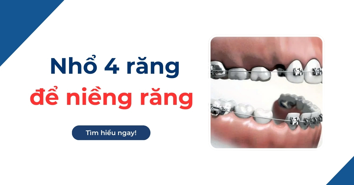 Nhổ 4 răng để niềng răng có đau không? Có nguy hiểm không?