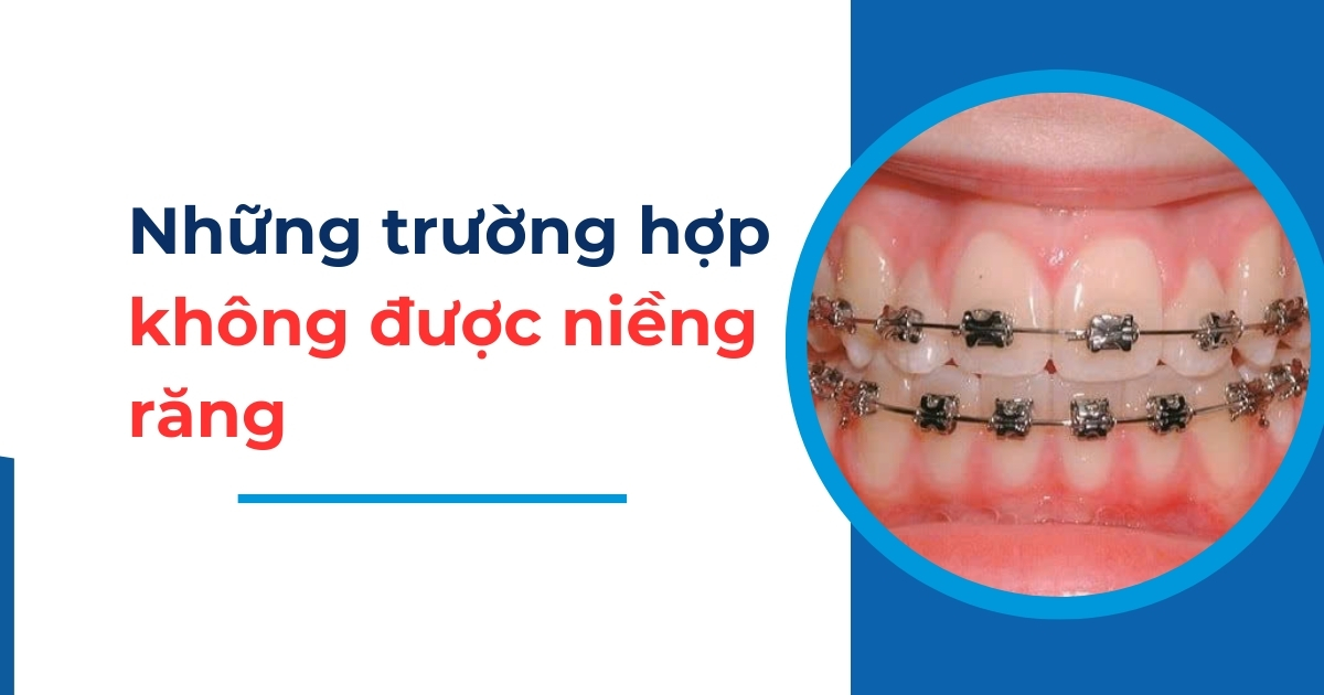 Những trường hợp không được niềng răng bạn nên biết trước
