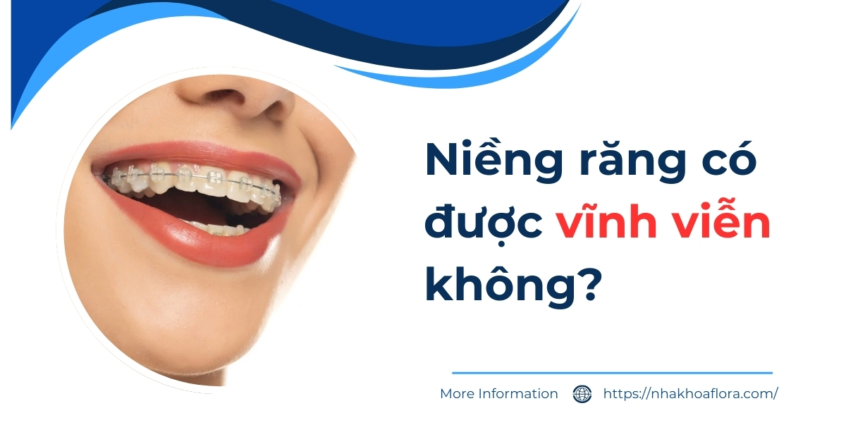 Niềng răng có được vĩnh viễn không? Có duy trì trọn đời?