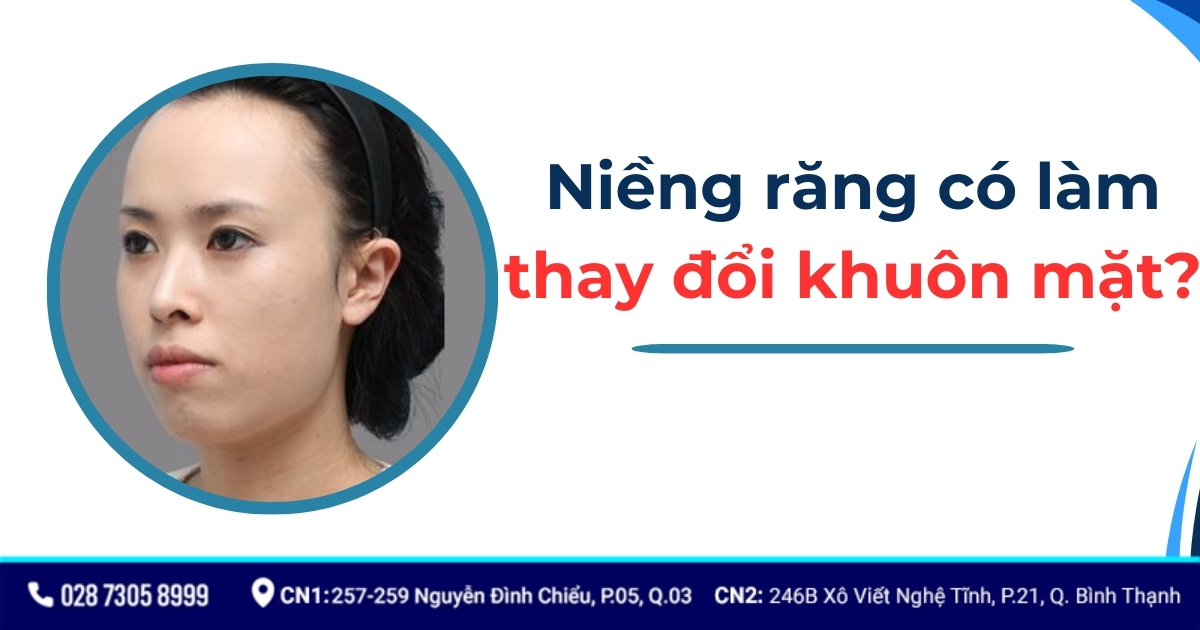 Niềng răng có làm thay đổi khuôn mặt? Tác động như thế nào?