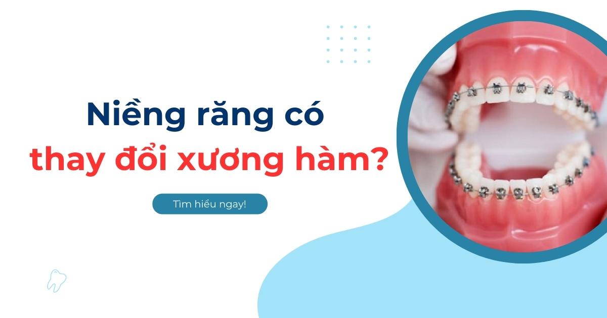 Niềng răng có thay đổi xương hàm? Tác động như thế nào?