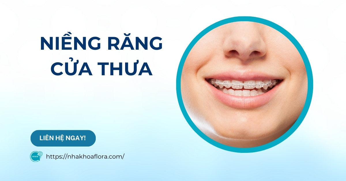 Niềng răng cửa thưa có được hay không? Giá bao nhiêu tiền?