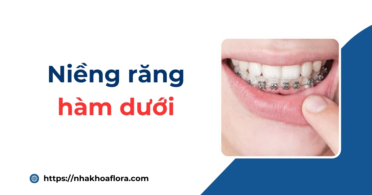 Niềng răng hàm dưới có được không? Chi phí bao nhiêu tiền?