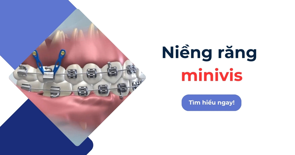 Niềng răng minivis là gì? Có tác dụng gì? Bao lâu thì tháo?
