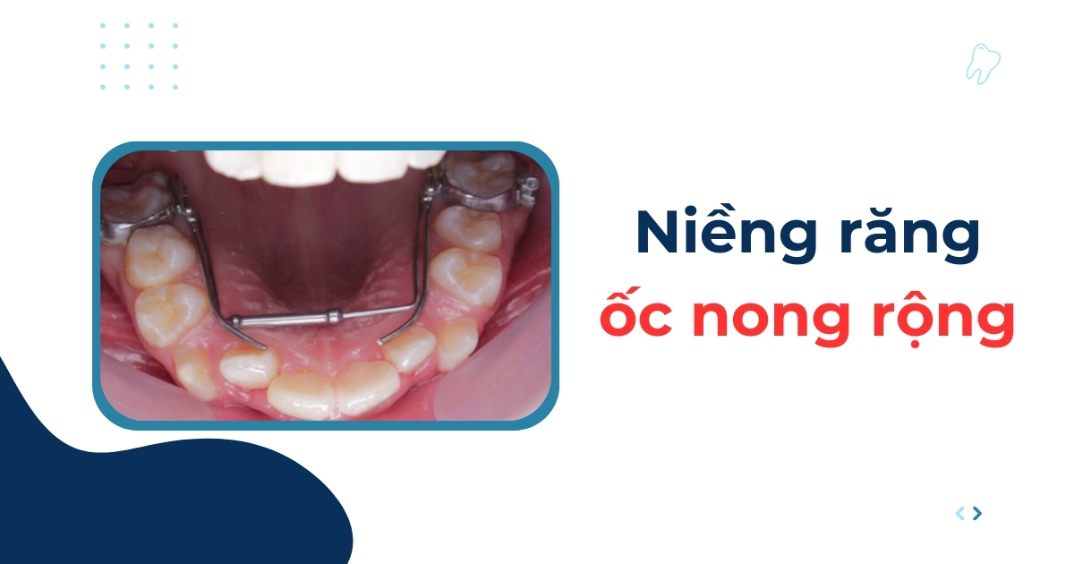Niềng răng ốc nong rộng là gì? Đối tượng thực hiện? Chi phí?