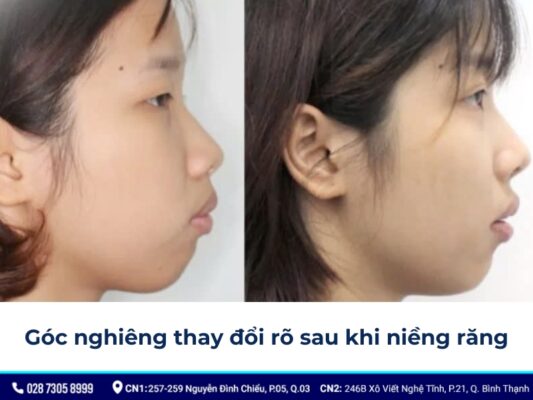 niềng răng thay đổi góc nghiêng - ảnh 5 niềng răng thay đổi góc nghiêng - ảnh 5