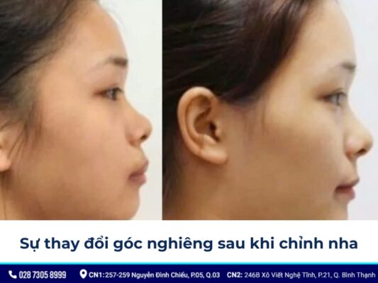 niềng răng thay đổi góc nghiêng - ảnh 6 niềng răng thay đổi góc nghiêng - ảnh 6
