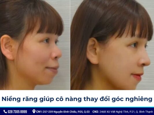 niềng răng thay đổi góc nghiêng - ảnh 7 niềng răng thay đổi góc nghiêng - ảnh 7