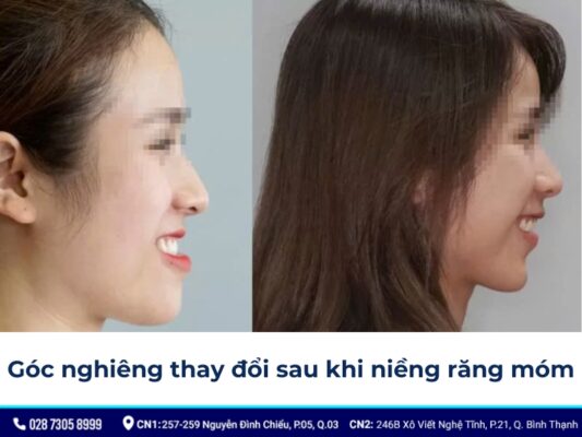 niềng răng thay đổi góc nghiêng - ảnh 8 niềng răng thay đổi góc nghiêng - ảnh 8