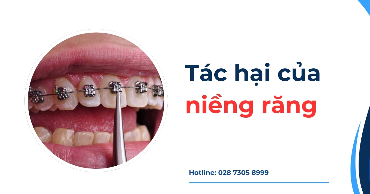 8 tác hại của niềng răng bạn nên biết trước khi thực hiện