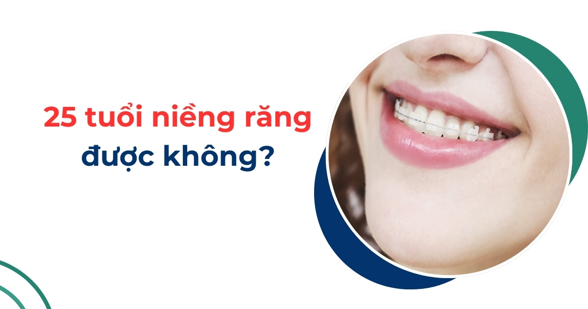 25 tuổi niềng răng được không? Mất bao lâu? Cần lưu ý gì?
