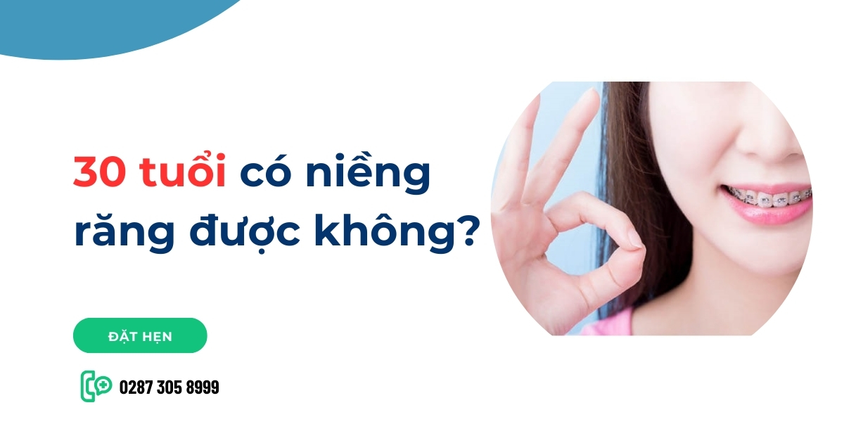 30 tuổi có niềng răng được không? Và cần lưu ý những gì?