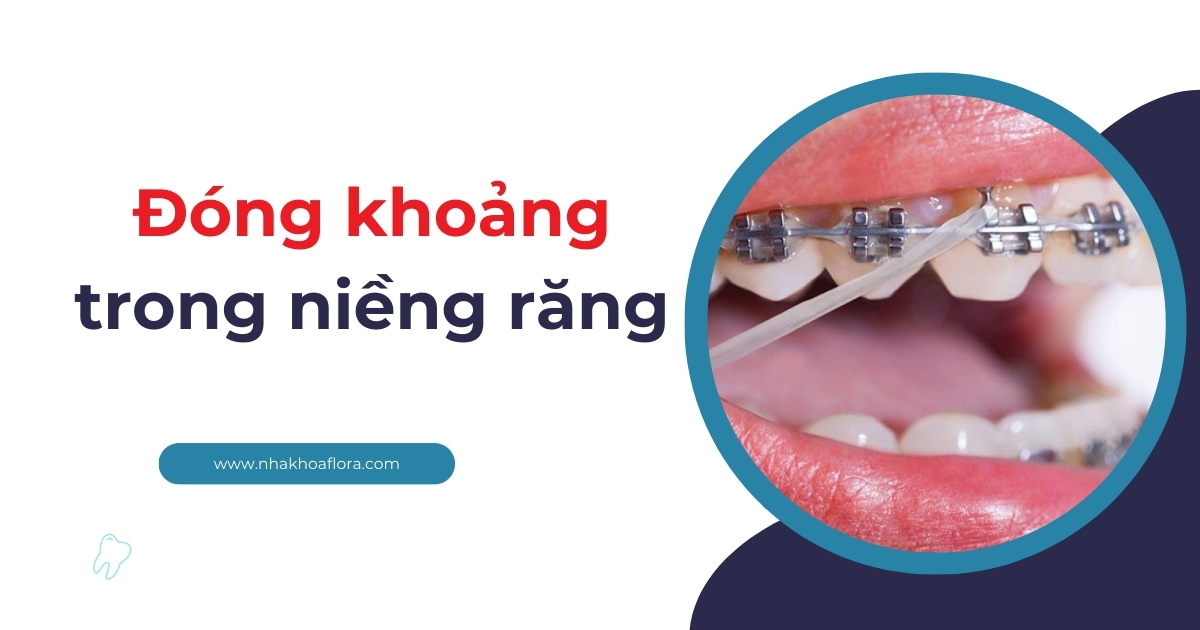 Đóng khoảng trong niềng răng là gì? Mất bao lâu thời gian?