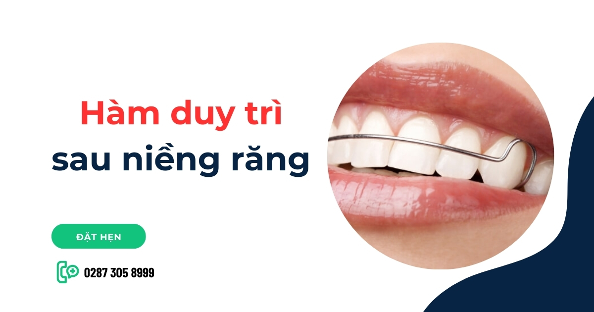Hàm duy trì sau niềng răng là gì? Thời gian đeo và Chi phí?