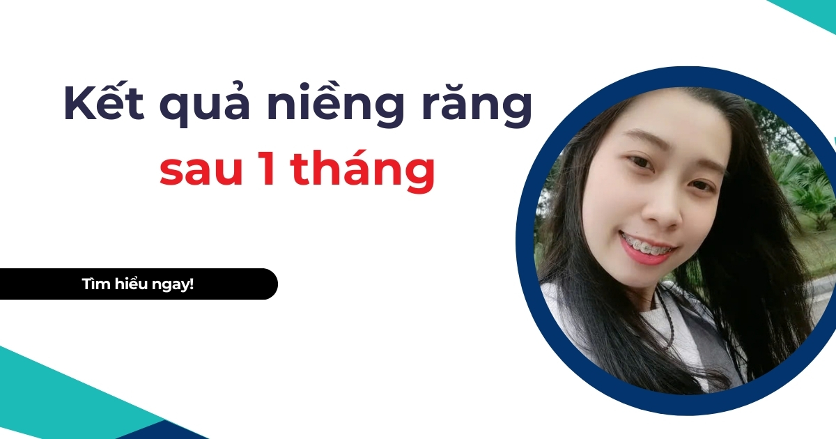 Kết quả niềng răng sau 1 tháng sẽ thay đổi như thế nào?