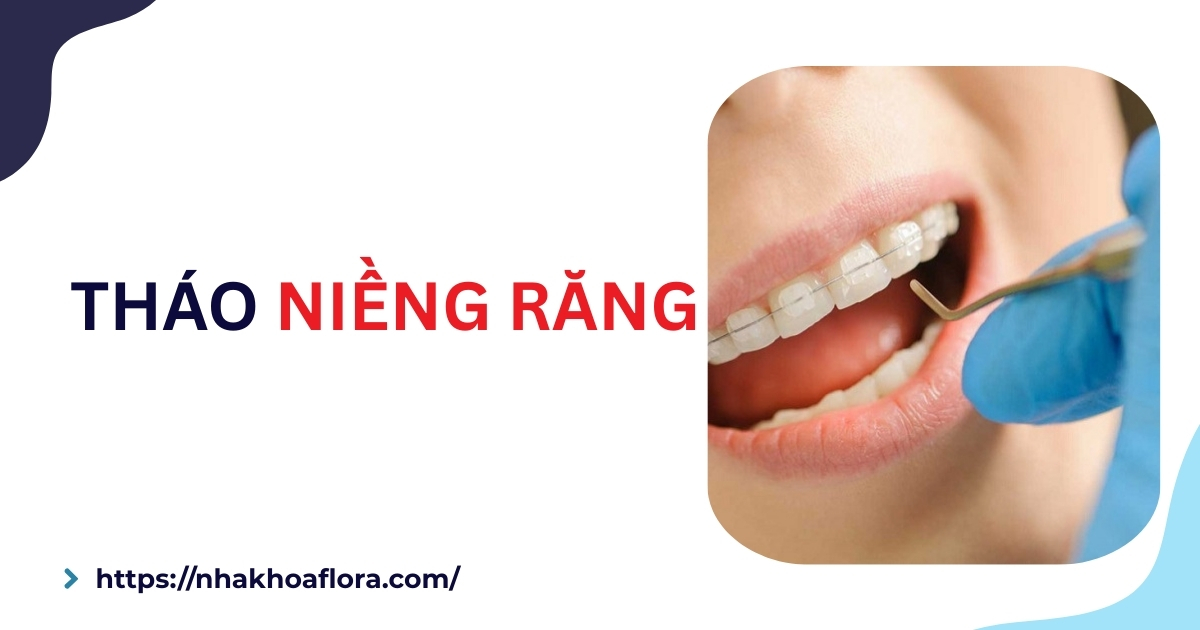 Tháo niềng răng mất bao lâu? Có đau không? Bao nhiêu tiền?