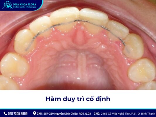 Hàm duy trì sau niềng răng giá bao nhiêu? - ảnh 2 Hàm duy trì sau niềng răng giá bao nhiêu? - ảnh 2