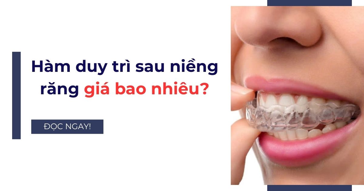 Hàm duy trì sau niềng răng giá bao nhiêu? Bảng giá 2025
