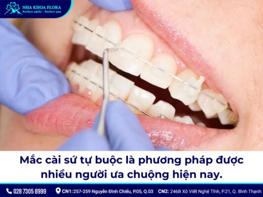 mắc cài sứ tự buộc - ảnh 1 mắc cài sứ tự buộc - ảnh 1