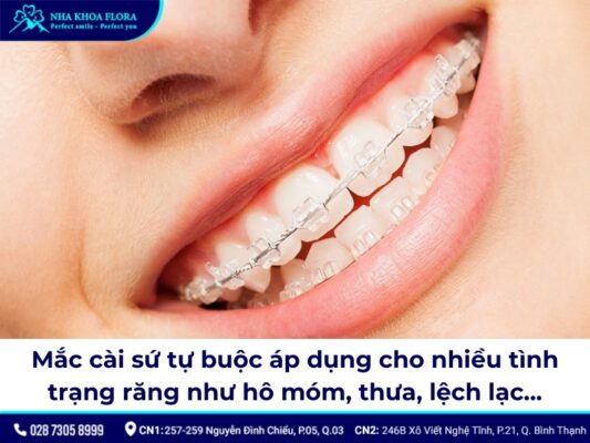 mắc cài sứ tự buộc - ảnh 2 mắc cài sứ tự buộc - ảnh 2
