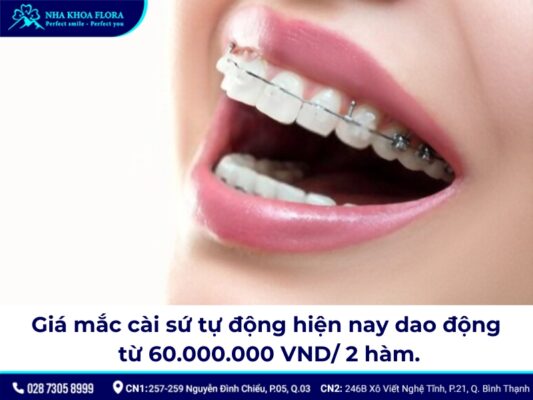 mắc cài sứ tự buộc - ảnh 3 mắc cài sứ tự buộc - ảnh 3
