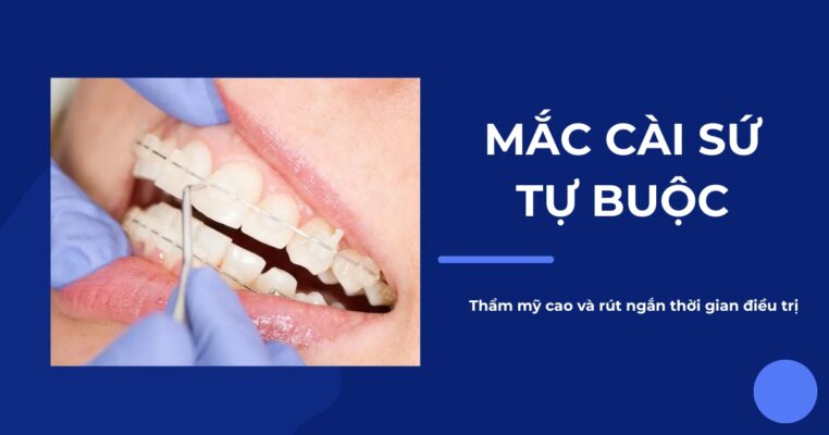mắc cài sứ tự buộc